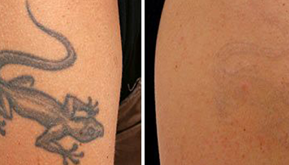 tattoo removal
