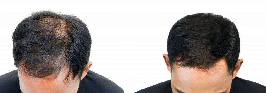 hair transplant