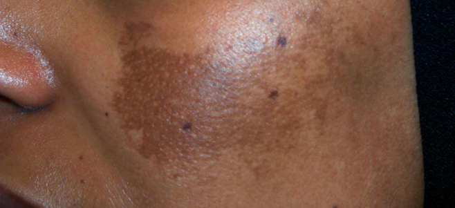 melasma
