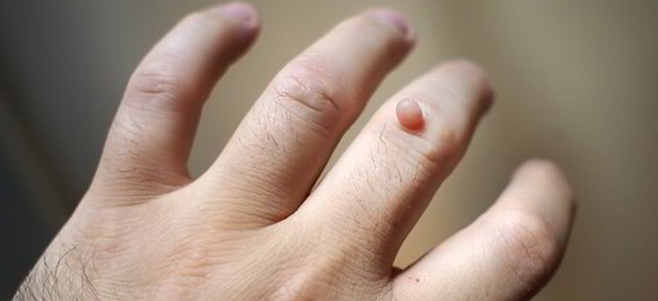 wart removal